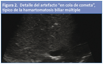 Figura 2. Detalle del artefacto “en cola de cometa”, típico de la hamartomatosis biliar múltiple
