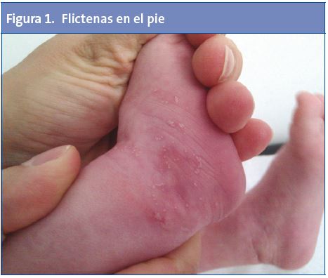 Figura 1. Flictenas en el pie