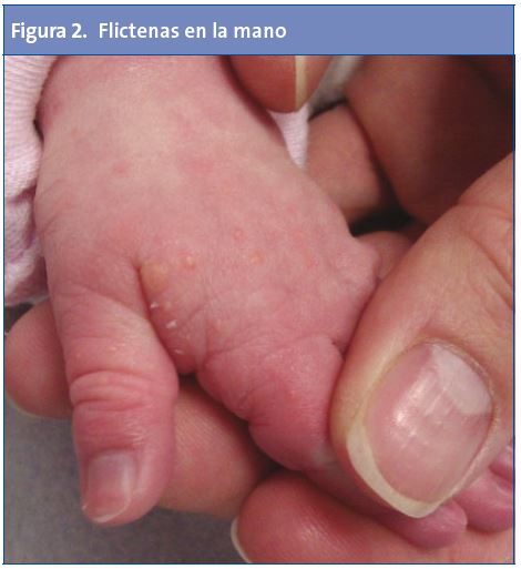 Figura 2. Flictenas en la mano