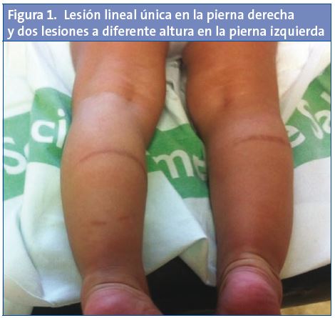 Figura 1. Lesión lineal única en la pierna derecha y dos lesiones a diferente altura en la pierna izquierda