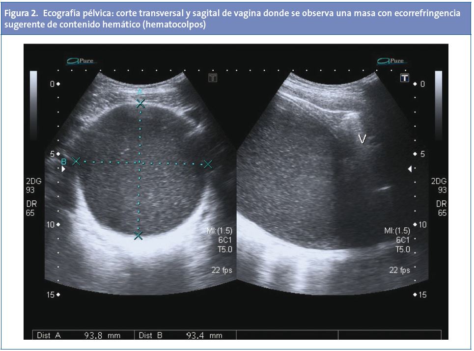 Figura 2. Ecografía pélvica: corte transversal y sagital de vagina donde se observa una masa con ecorrefringencia sugerente de contenido hemático (hematocolpos)