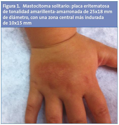 Figura 1. Mastocitoma solitario: placa eritematosa de tonalidad amarillenta-amarronada de 25x18 mm de diámetro, con una zona central más indurada de 10x15 mm
