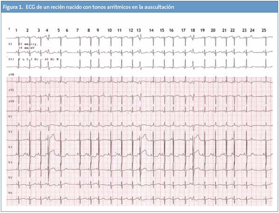 Figura 1. ECG de un recién nacido con tonos arrítmicos en la auscultación