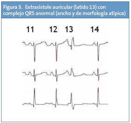 Figura 3. Extrasístole auricular (latido 13) con complejo QRS anormal (ancho y de morfología atípica)
