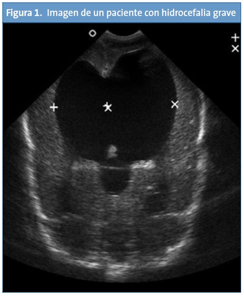 Figura 1. Imagen de un paciente con hidrocefalia grave