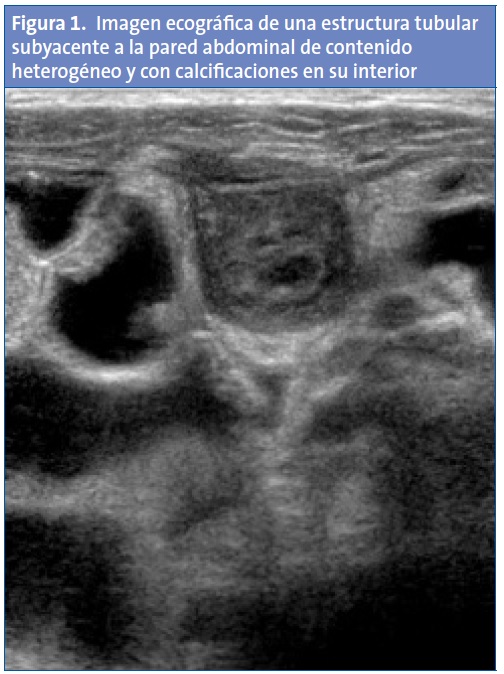 Figura 1. Imagen ecográfica de una estructura tubular subyacente a la pared abdominal de contenido heterogéneo y con calcificaciones en su interior