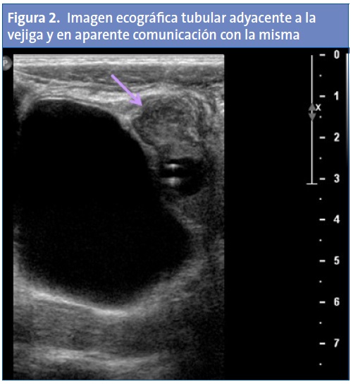 Figura 2. Imagen ecográfica tubular adyacente a la vejiga y en aparente comunicación con la misma