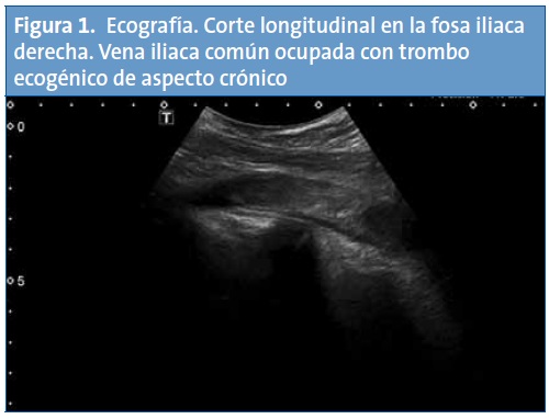 Figura 1. Ecografía. Corte longitudinal en la fosa iliaca derecha. Vena iliaca común ocupada con trombo ecogénico de aspecto crónico