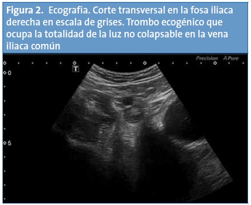 Figura 2. Ecografía. Corte transversal en la fosa iliaca derecha en escala de grises. Trombo ecogénico que ocupa la totalidad de la luz no colapsable en la vena iliaca común