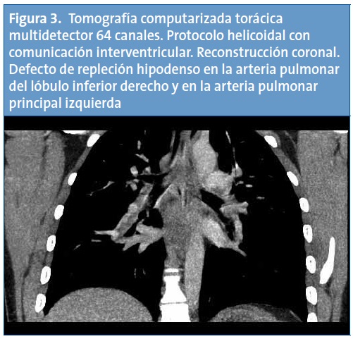 Figura 3. Tomografía computarizada torácica multidetector 64 canales. Protocolo helicoidal con comunicación interventricular. Reconstrucción coronal. Defecto de repleción hipodenso en la arteria pulmonar del lóbulo inferior derecho y en la arteria pulmonar principal izquierda