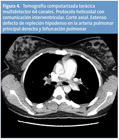 Figura 4. Tomografía computarizada torácica multidetector 64 canales. Protocolo helicoidal con comunicación interventricular. Corte axial. Extenso defecto de repleción hipodenso en la arteria pulmonar principal derecha y bifurcación pulmonar