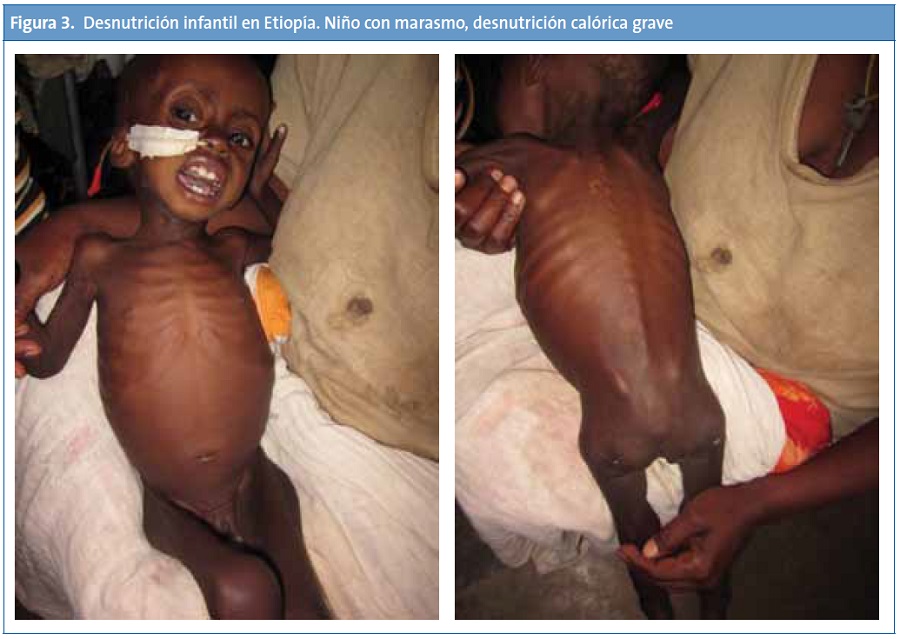 Figura 3. Desnutrición infantil en Etiopía. Niño con marasmo, desnutrición calórica grave