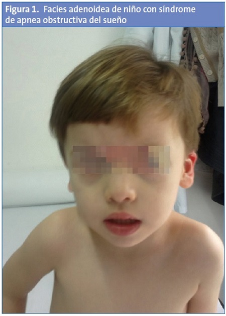 Figura 1. Facies adenoidea de niño con síndrome de apnea obstructiva del sueño