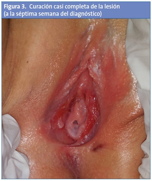 Figura 3. Curación casi completa de la lesión (a la séptima semana del diagnóstico)