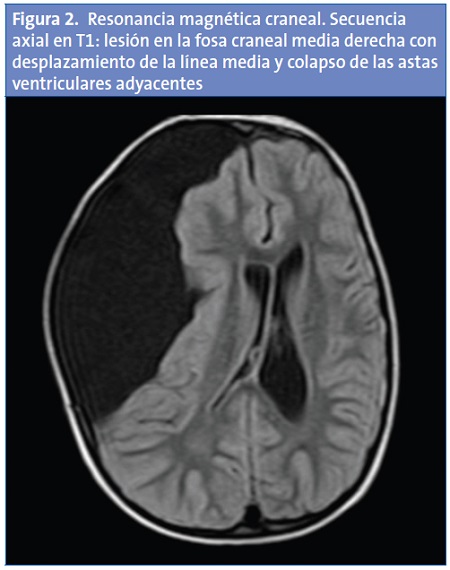 Figura 2. Resonancia magnética craneal. Secuencia axial en T1: lesión en la fosa craneal media derecha con desplazamiento de la línea media y colapso de las astas ventriculares adyacentes