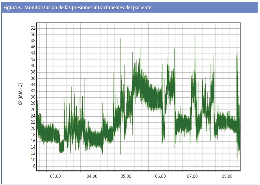 Figura 3. Monitorización de las presiones intracraneales del paciente