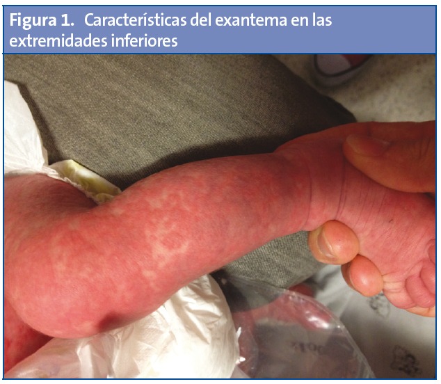 Figura 1. Características del exantema en las extremidades inferiores