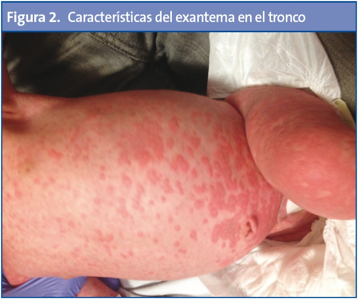 Figura 2. Características del exantema en el tronco