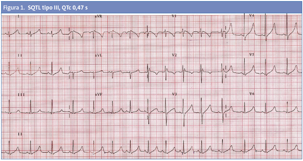 Figura 1. SQTL tipo III, QTc 0,47 s