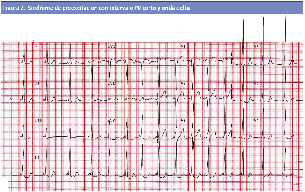Figura 2. Síndrome de preexcitación con intervalo PR corto y onda delta