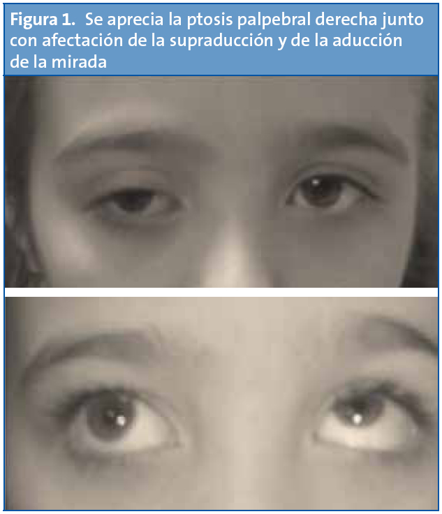 Figura 1. Se aprecia la ptosis palpebral derecha junto con afectación de la supraducción y de la aducción de la mirada