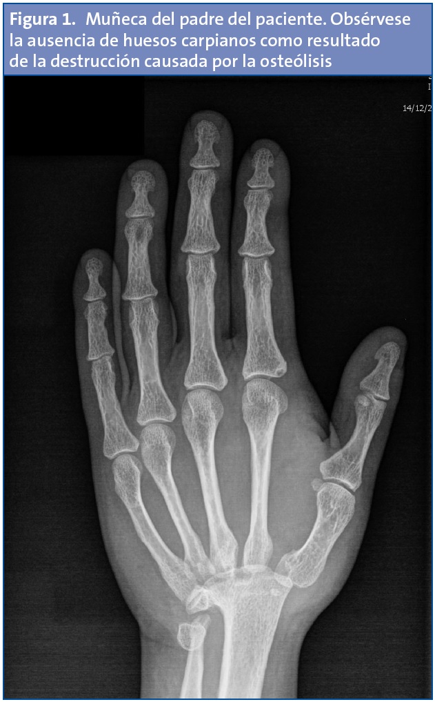 Figura 1. Muñeca del padre del paciente. Obsérvese la ausencia de huesos carpianos como resultado de la destrucción causada por la osteólisis