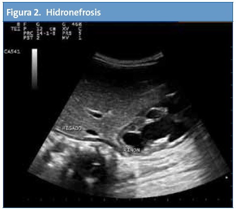 Figura 2. Dilatación hidronefrosis