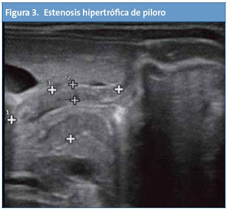 Figura 3. Estenosis hipertrófica de píloro