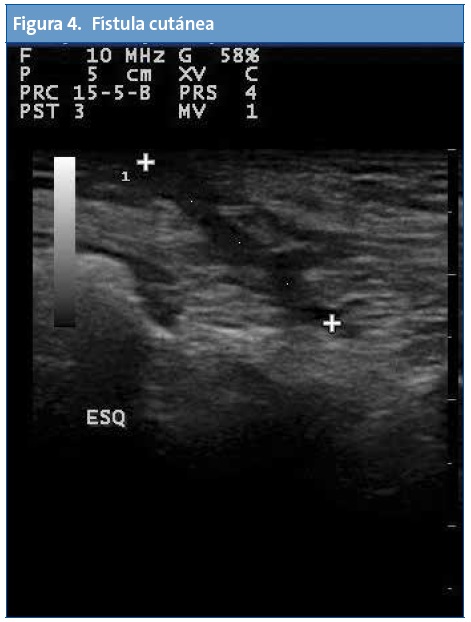 Figura 4. Fístula cutánea