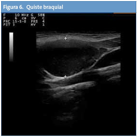 Figura 6. Quiste braquial