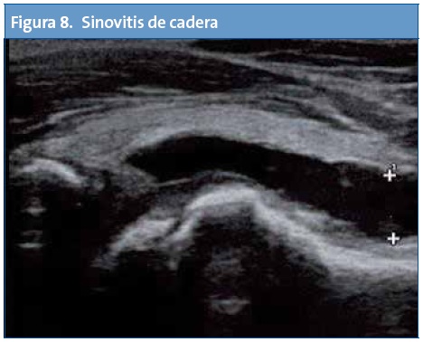 Figura 8. Sinovitis de cadera