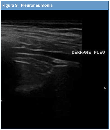 Figura 9. Pleuroneumonía