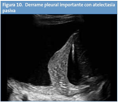Figura 10. Derrame pleural importante con atelectasia pasiva