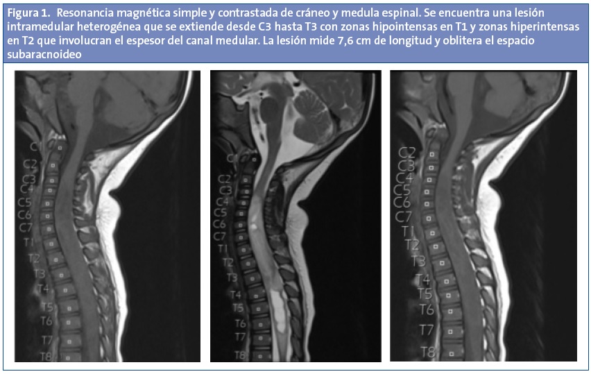 Figura 1. Resonancia magnética simple y contrastada de cráneo y medula espinal. Se encuentra una lesión intramedular heterogénea que se extiende desde C3 hasta T3 con zonas hipointensas en T1 y zonas hiperintensas en T2 que involucran el espesor del canal medular. La lesión mide 7,6 cm de longitud y oblitera el espacio subaracnoideo