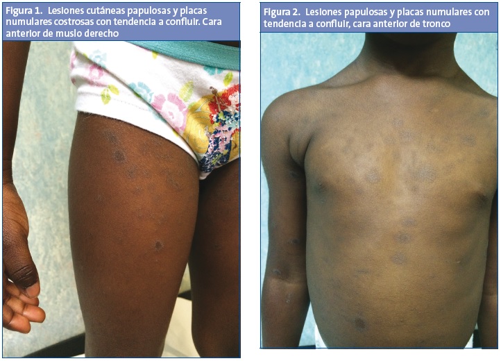 Figura 1. Lesiones cutáneas papulosas y placas numulares costrosas con tendencia a confluir. Cara anterior de muslo derecho. Figura 2. Lesiones papulosas y placas numulares con tendencia a confluir, cara anterior de tronco
