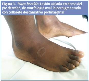 Figura 3. Placa heraldo. Lesión aislada en dorso del pie derecho, de morfología oval, hiperpigmentada con collarete descamativo perimarginal