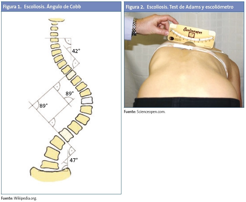 Figura 1. Escoliosis. Ángulo de Cobb. Figura 2. Escoliosis. Test de Adams y escoliómetro