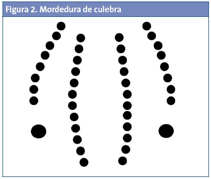 Figura 2. Mordedura de culebra