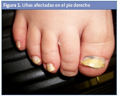 Figura 1. Uñas afectadas en el pie derecho