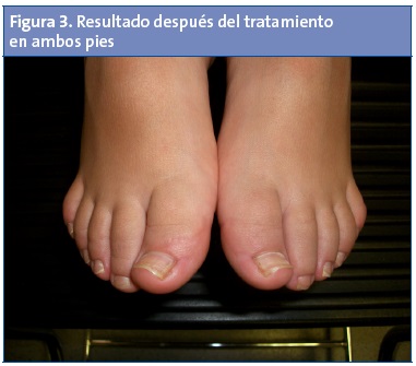 Figura 3. Resultado después del tratamiento en ambos pies
