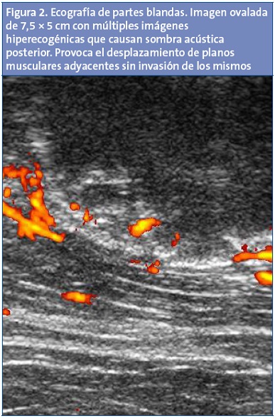Figura 2. Ecografía de partes blandas. Imagen ovalada de 7,5 × 5 cm con múltiples imágenes hiperecogénicas que causan sombra acústica posterior. Provoca el desplazamiento de planos musculares adyacentes sin invasión de los mismos