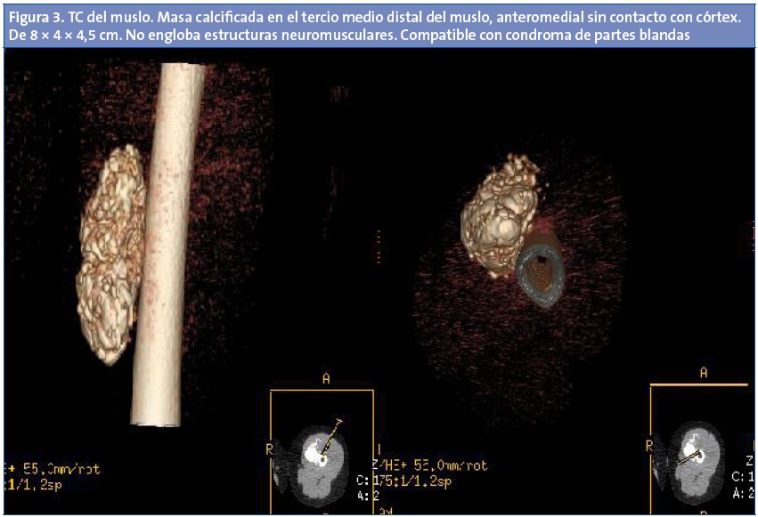 Figura 3. TC del muslo. Masa calcificada en el tercio medio distal del muslo, anteromedial sin contacto con córtex. De 8 × 4 × 4,5 cm. No engloba estructuras neuromusculares. Compatible con condroma de partes blandas