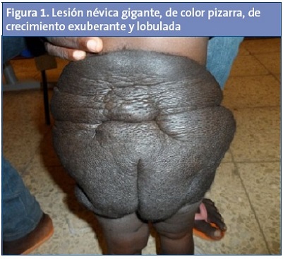 Figura 1. Lesión névica gigante, de color pizarra, de crecimiento exuberante y lobulada.