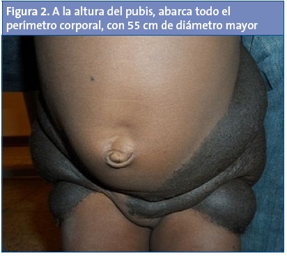 Figura 2. A la altura del pubis, abarca todo el perímetro corporal, con 55 cm de diámetro mayor.
