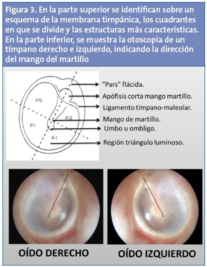 Figura 3. En la parte superior se identifican sobre un esquema de la membrana timpánica, los cuadrantes en que se divide y las estructuras más características. En la parte inferior, se muestra la otoscopia de un tímpano derecho e izquierdo, indicando la dirección del mango del martillo