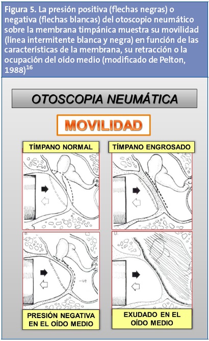 Figura 5. La presión positiva (flechas negras) o negativa (flechas blancas) del otoscopio neumático sobre la membrana timpánica muestra su movilidad (línea intermitente blanca y negra) en función de las características de la membrana, su retracción o la ocupación del oído medio (modificado de Pelton, 1988)