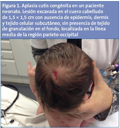 Figura 1. Aplasia cutis congénita en un paciente neonato. Lesión excavada en el cuero cabelludo de 1,5 × 1,5 cm con ausencia de epidermis, dermis y tejido celular subcutáneo, sin presencia de tejido de granulación en el fondo, localizada en la línea media de la región parieto-occipital