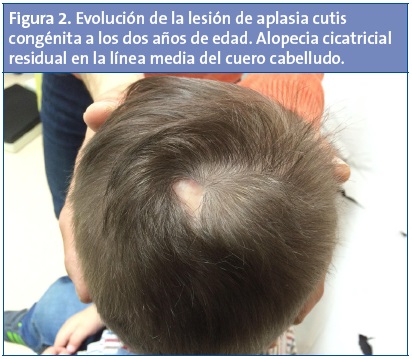 Figura 2. Evolución de la lesión de aplasia cutis congénita a los dos años de edad. Alopecia cicatricial residual en la línea media del cuero cabelludo