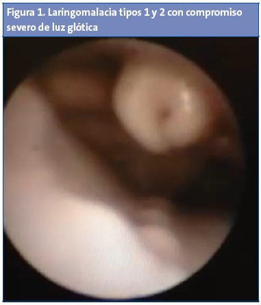 Figura 1. Laringomalacia tipos 1 y 2 con compromiso severo de luz glótica