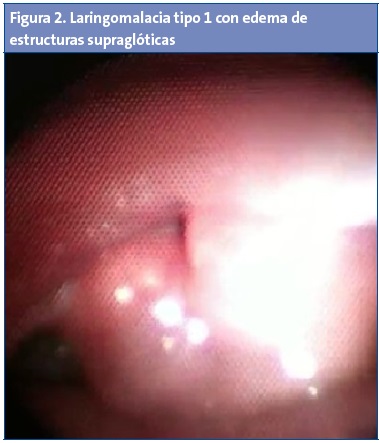 Figura 2. Laringomalacia tipo 1 con edema de estructuras supraglóticas